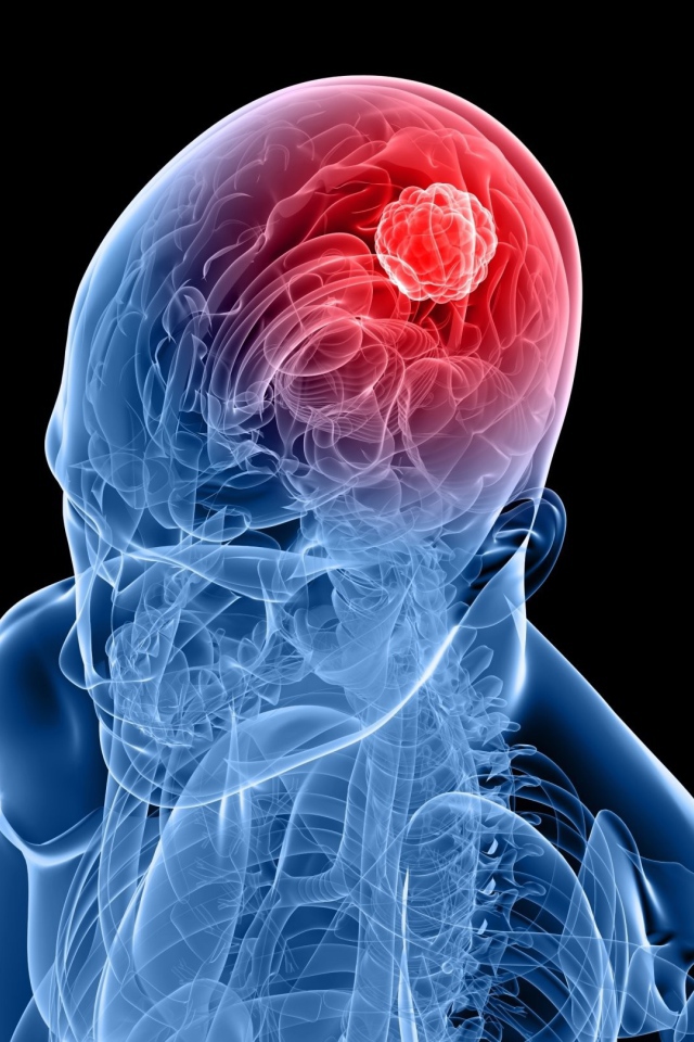 Очаг возбуждения в мозгу человека